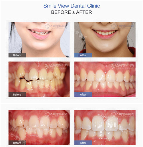 江南SMILE VIEW牙科牙齿矫正对比照