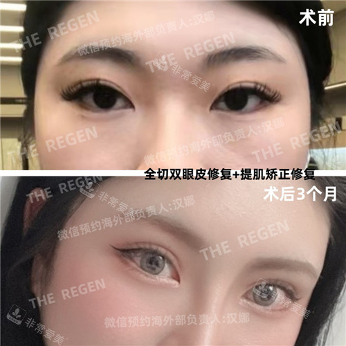 韓國JN整形外科眼修復(fù)對比 韓國JN整形外科眼修復(fù)對比