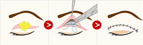 全切双眼皮流程图