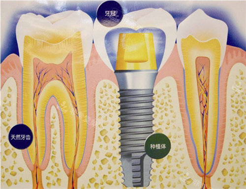 种植牙