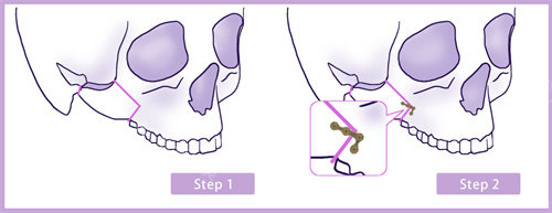 顴骨縮小手術固定圖