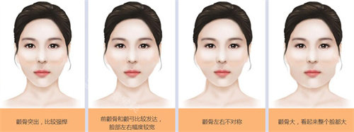 不同程度的顴骨突出情況對(duì)比 不同程度的顴骨突出情況對(duì)比