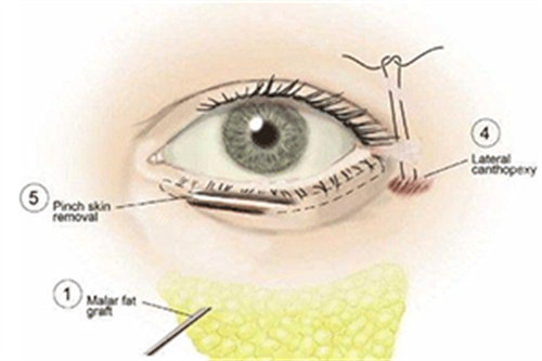 祛眼袋手术