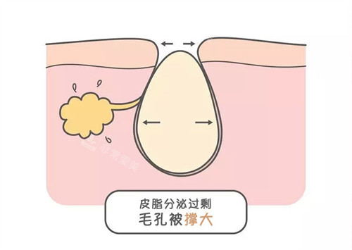 皮肤油脂分泌过剩毛孔变大