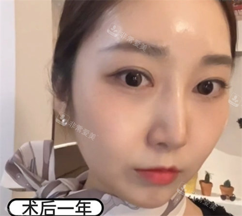 韓國迪美整形術(shù)后