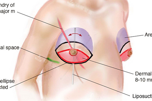 乳晕缩小术