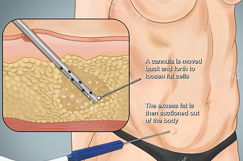 吸脂手术示意图