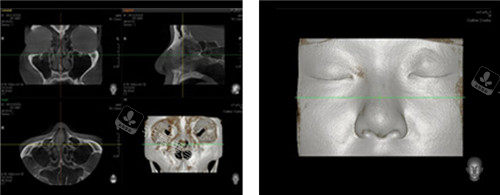 韓國(guó)miplus整形鼻子ct設(shè)計(jì)圖