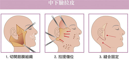 中下面部拉皮手术流程图