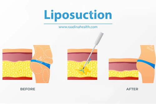 吸脂前后人体变化和脂肪层变化