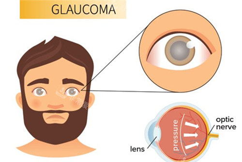 青光眼的卡通图