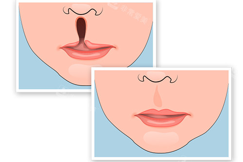 唇腭裂矫正前后对比