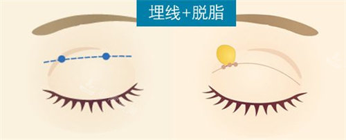 埋线双眼皮动画图 埋线双眼皮动画图