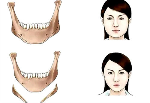 下颌角手术前后对比图