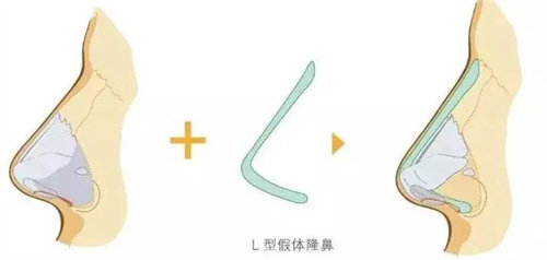 L型假体动画展示图 L型假体动画展示图