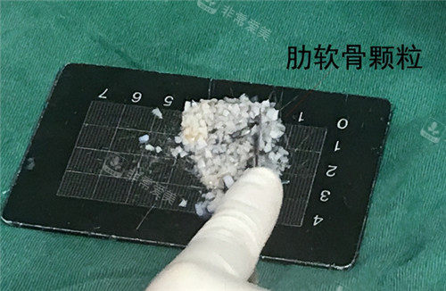 肋軟骨顆粒照片