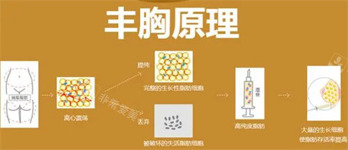 脂肪丰胸原理 脂肪丰胸原理