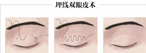 埋线双眼皮 埋线双眼皮