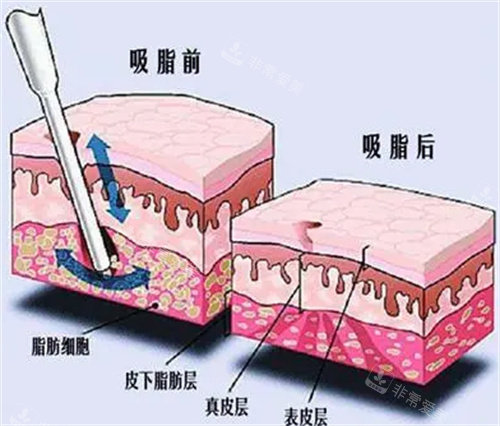 吸脂后脂肪图 吸脂后脂肪图