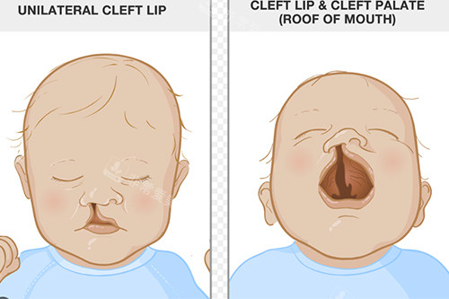 重度唇腭裂小朋友