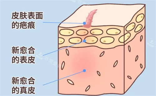 疤痕修復(fù)過程動畫圖