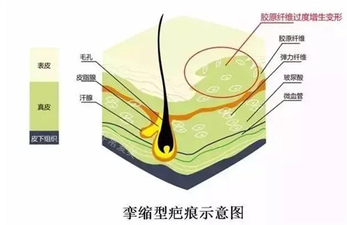 攣縮性疤痕示意圖