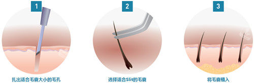 韩国毛杰琳整形植发手术细节步骤图