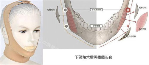 下頜角手術動畫圖