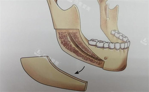 下颌角截骨手术操作图