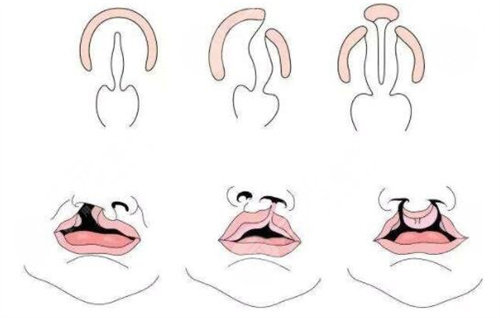 唇腭裂三种不同程度展示图