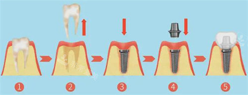 种植牙全过程