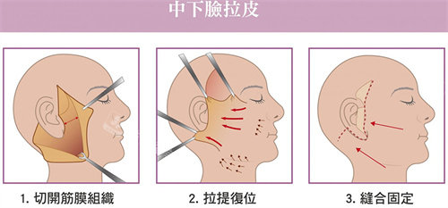 中下面部拉皮手术流程图