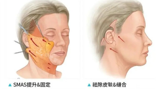 拉皮手術(shù)前后對比圖