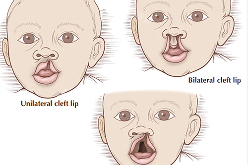 唇腭裂不同症状