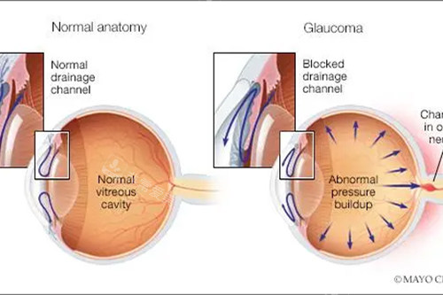 青光眼和正常眼睛的对比