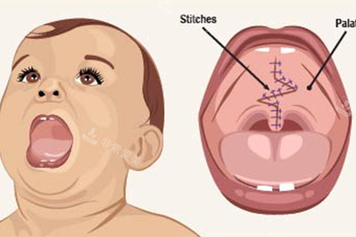 腭裂修复