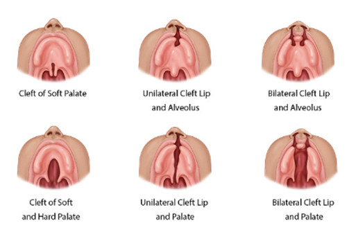 唇腭裂的多种情况