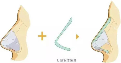 假體隆鼻 假體隆鼻