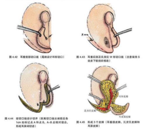 耳再造手术流程图