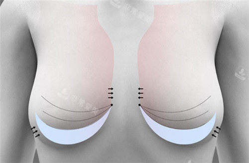 韩国ucanb整形胸部设计图