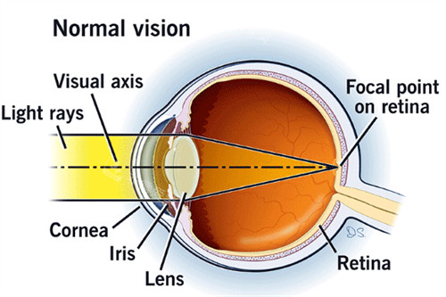 激光近视眼手术解析