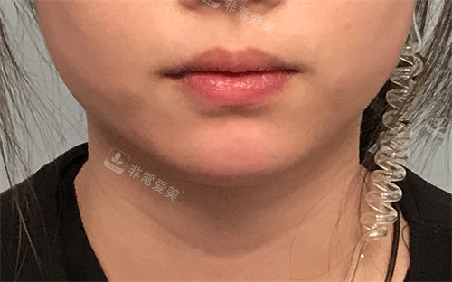 下巴填充前照片
