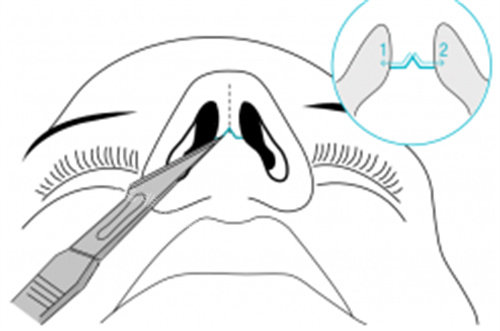 鼻头缩小手术图解