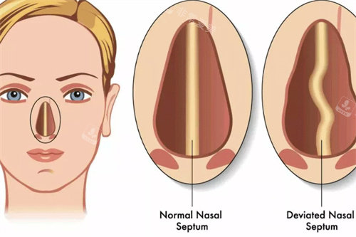 S型歪鼻与正常鼻子的区别