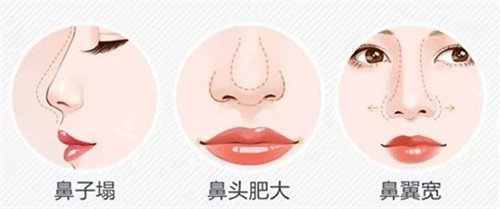 鼻子缺陷問(wèn)題圖 鼻子缺陷問(wèn)題圖