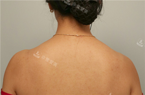 Toxnfill醫(yī)院斜方肌改善術(shù)前圖