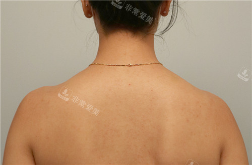 Toxnfill醫(yī)院斜方肌改善術(shù)后圖