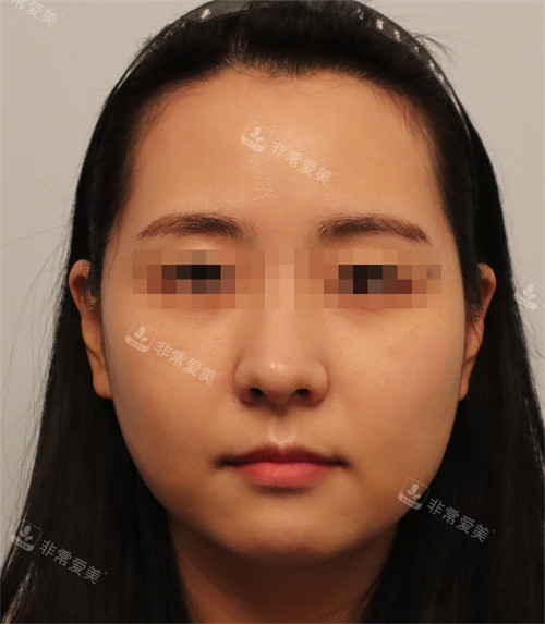 韓國Toxnfill調(diào)整之前的面部狀態(tài) 韓國Toxnfill調(diào)整之前的面部狀態(tài)