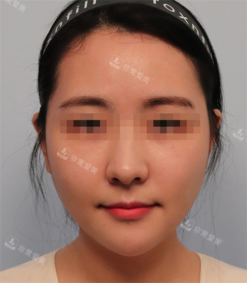 韓國Toxnfill調(diào)整后的面部狀態(tài) 韓國Toxnfill調(diào)整后的面部狀態(tài)