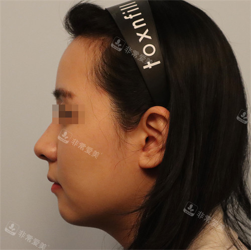 韓國Toxnfill調(diào)整打前側(cè)臉輪廓 韓國Toxnfill調(diào)整打前側(cè)臉輪廓